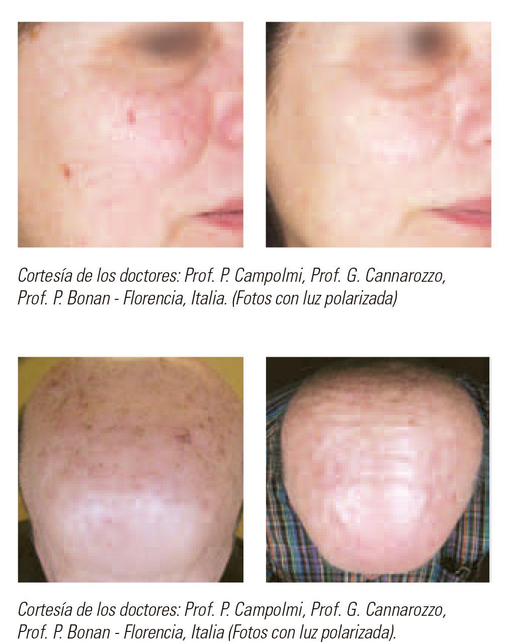 depilaipl1